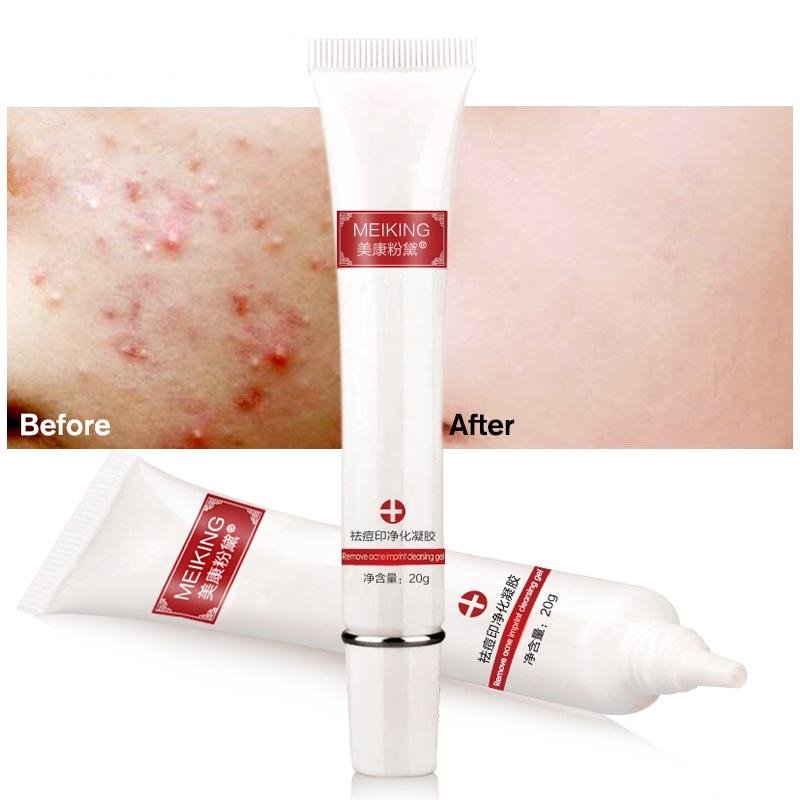 Hyaluronic Acid Face Cream Acne Scar Cream Removal